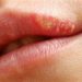 El herpes labial, causas más frecuentes de su aparición